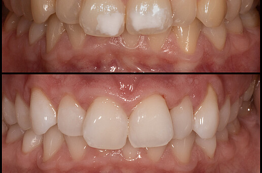 Before and after the treatment with bleaching and Icon Vestibular