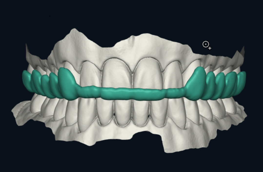 Teaser: DentaMile Connect Schiene Teaser: DentaMile Connect Schiene