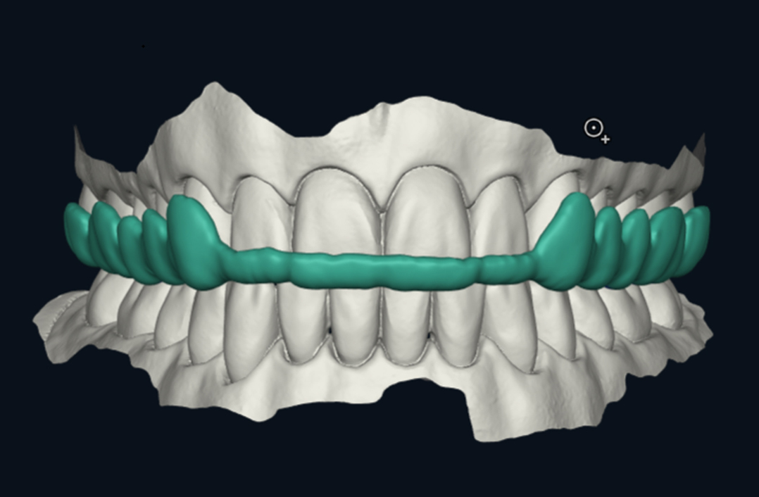 Teaser: DentaMile Connect Splint